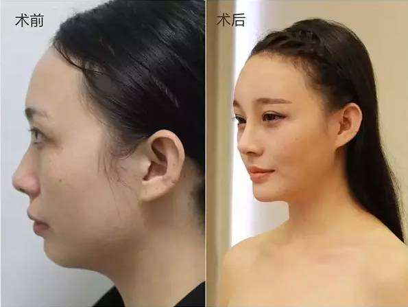王介聰隆鼻案例