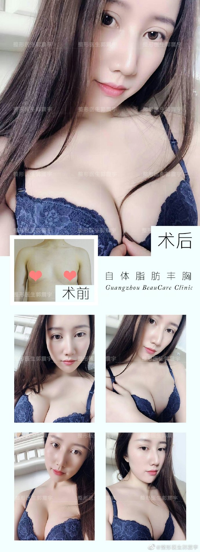 郭震宇脂肪豐胸案例