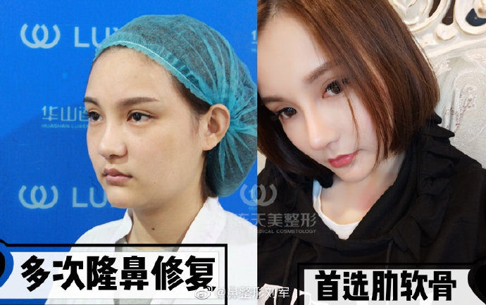 杭州連天美劉軍隆鼻案例