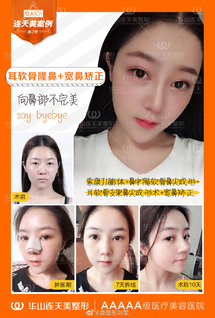 杭州連天美劉軍隆鼻案例