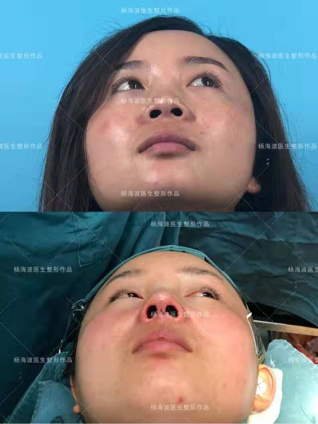 楊海波鼻綜合案例