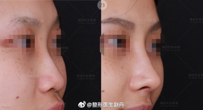 趙丹隆鼻案例