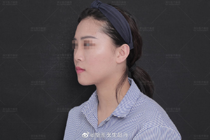 趙丹隆鼻案例