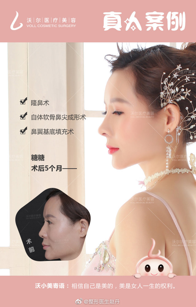 趙丹隆鼻案例