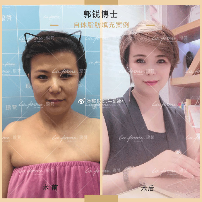 郭銳線雕面部提升
