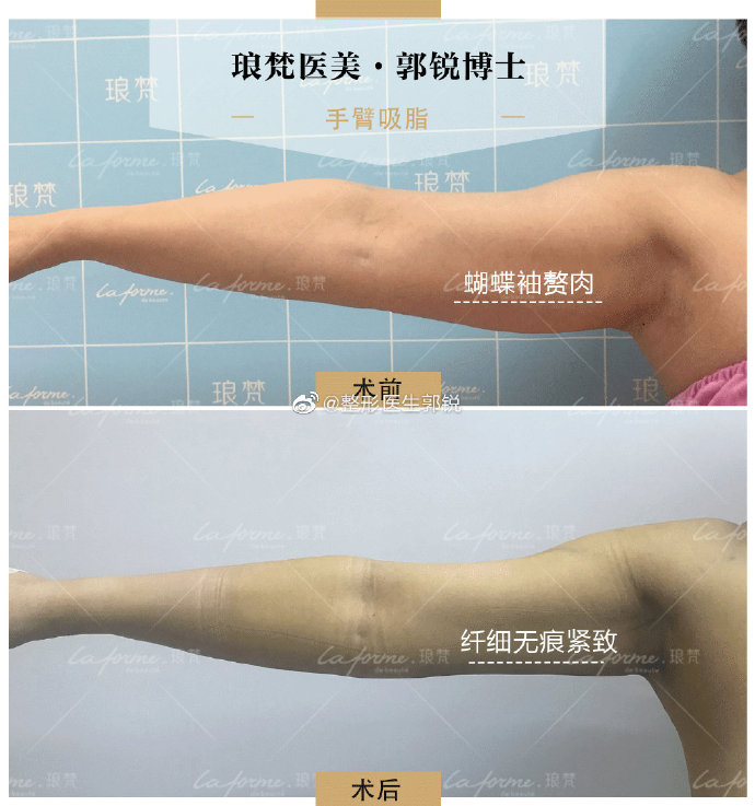 郭銳蝴蝶袖案例