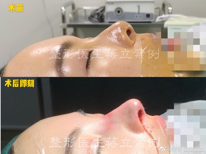 蔣立醫生鼻綜合案例