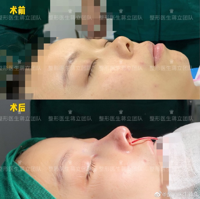 蔣立鼻綜合案例