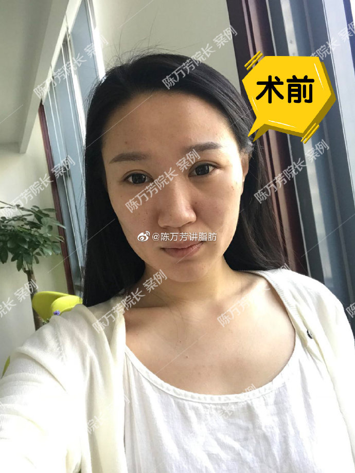 陳萬芳面部吸脂案例