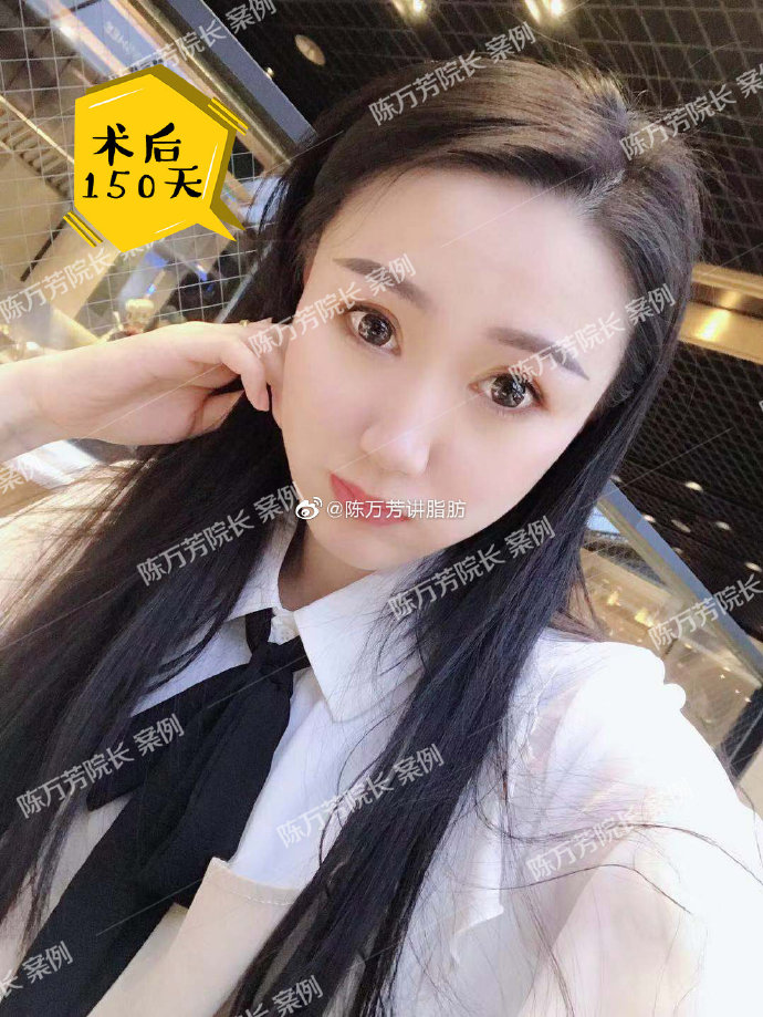 陳萬芳面部吸脂案例