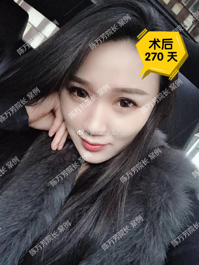 陳萬芳吸脂案例