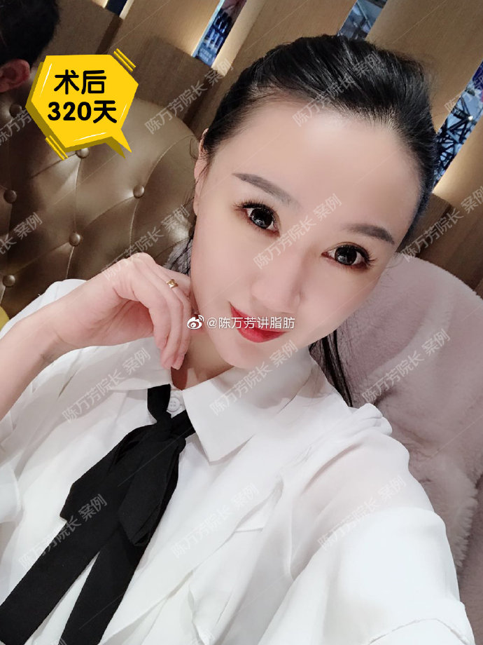 陳萬芳吸脂案例