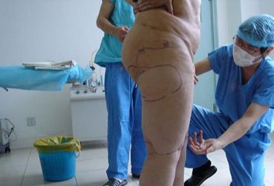 北京大腿吸脂哪個醫(yī)生性價比高？王志堅和李京霖哪個技術(shù)好？