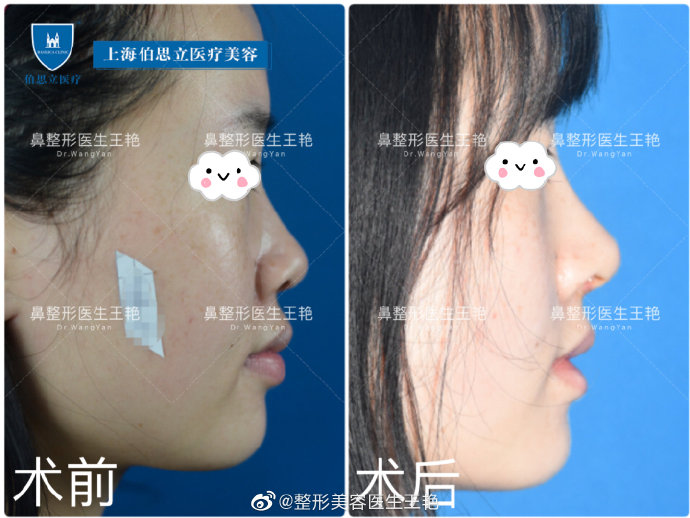 王艷全肋鼻綜合案例