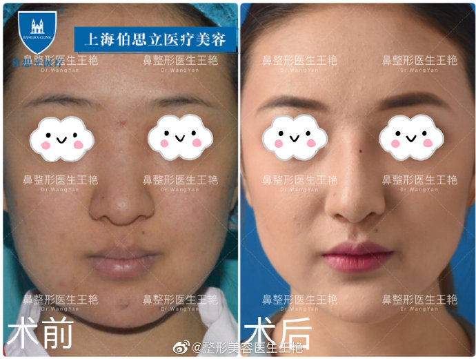 王艷鼻中隔隆鼻案例