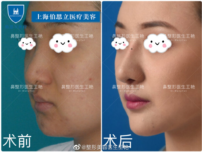 王艷鼻中隔綜合案例