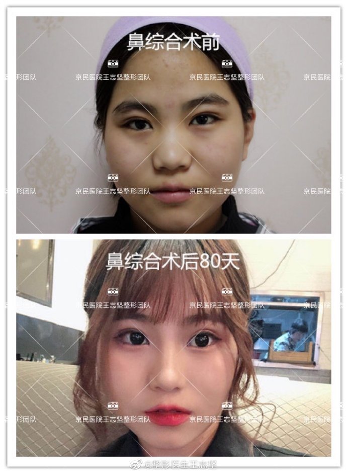 王志堅鼻綜合案例