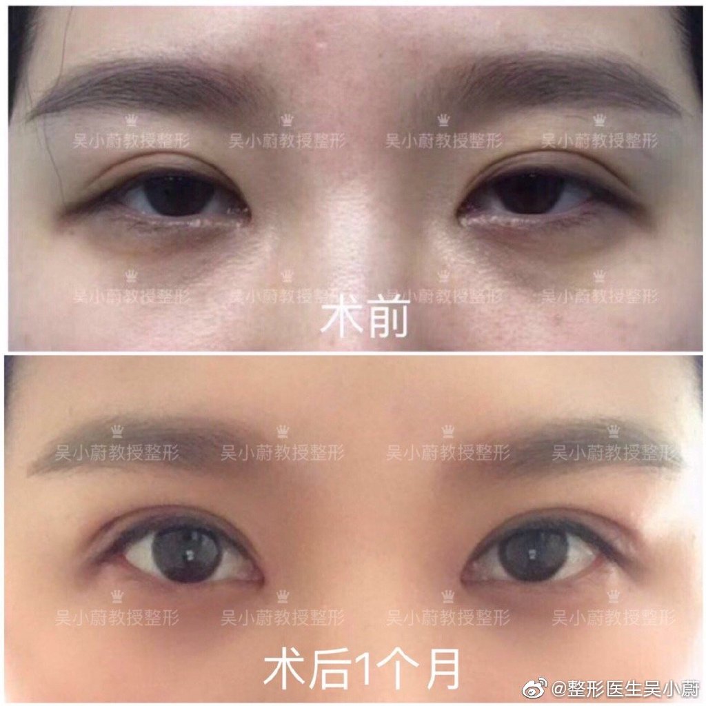 吳小蔚雙眼皮修復案例