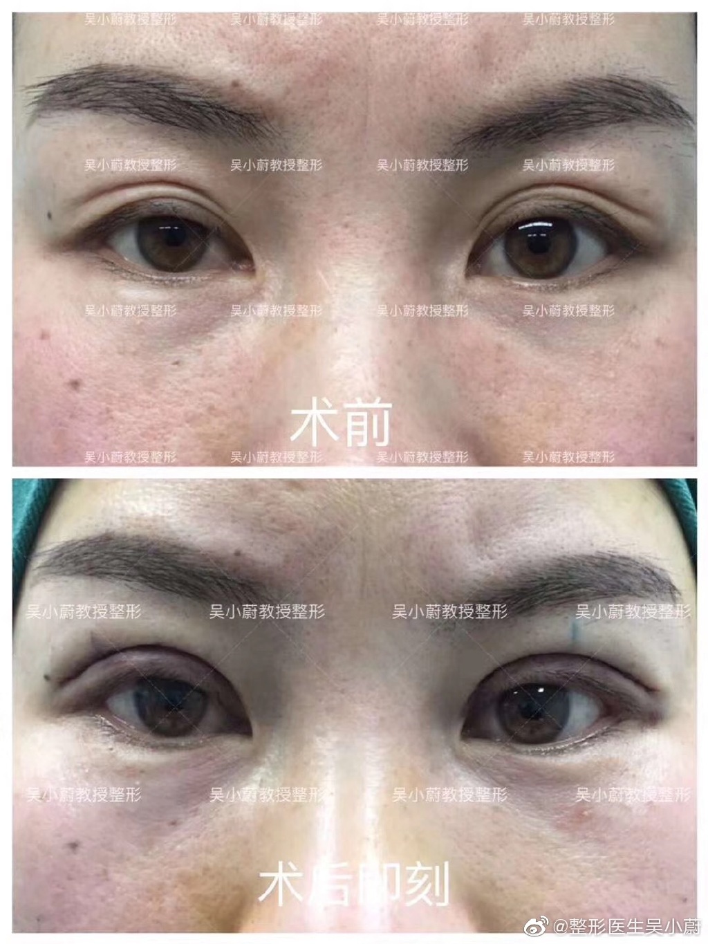 吳小蔚雙眼皮修復案例