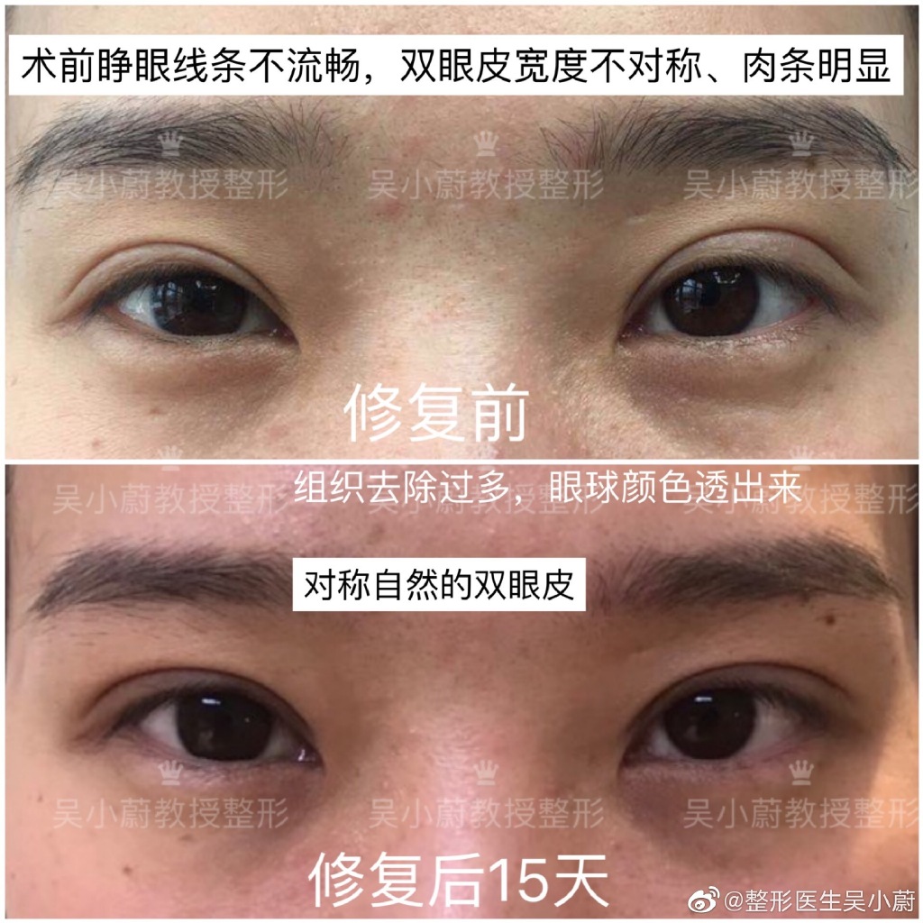 吳小蔚雙眼皮修復案例