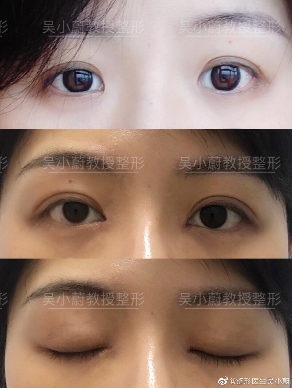 吳小蔚雙眼皮修復案例
