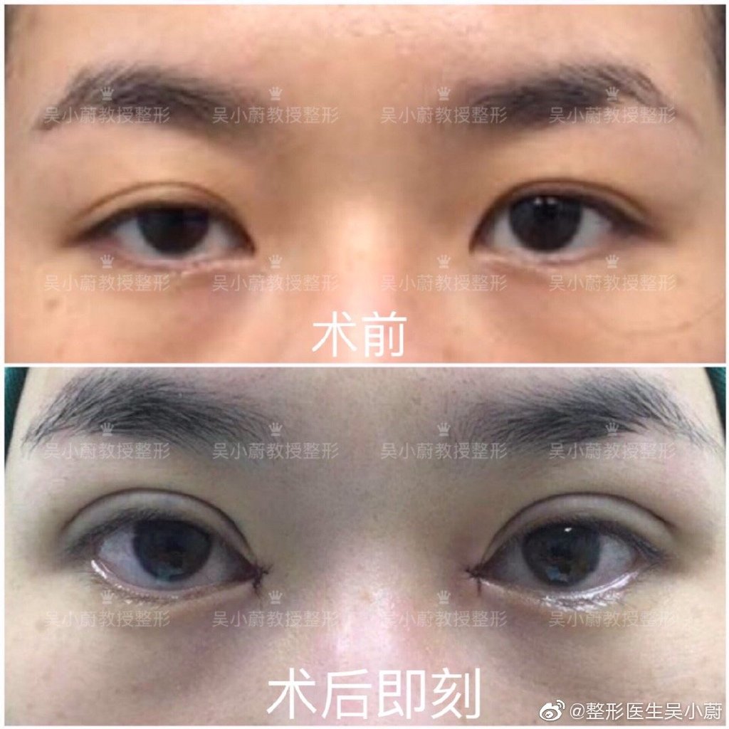 吳小蔚雙眼皮修復案例