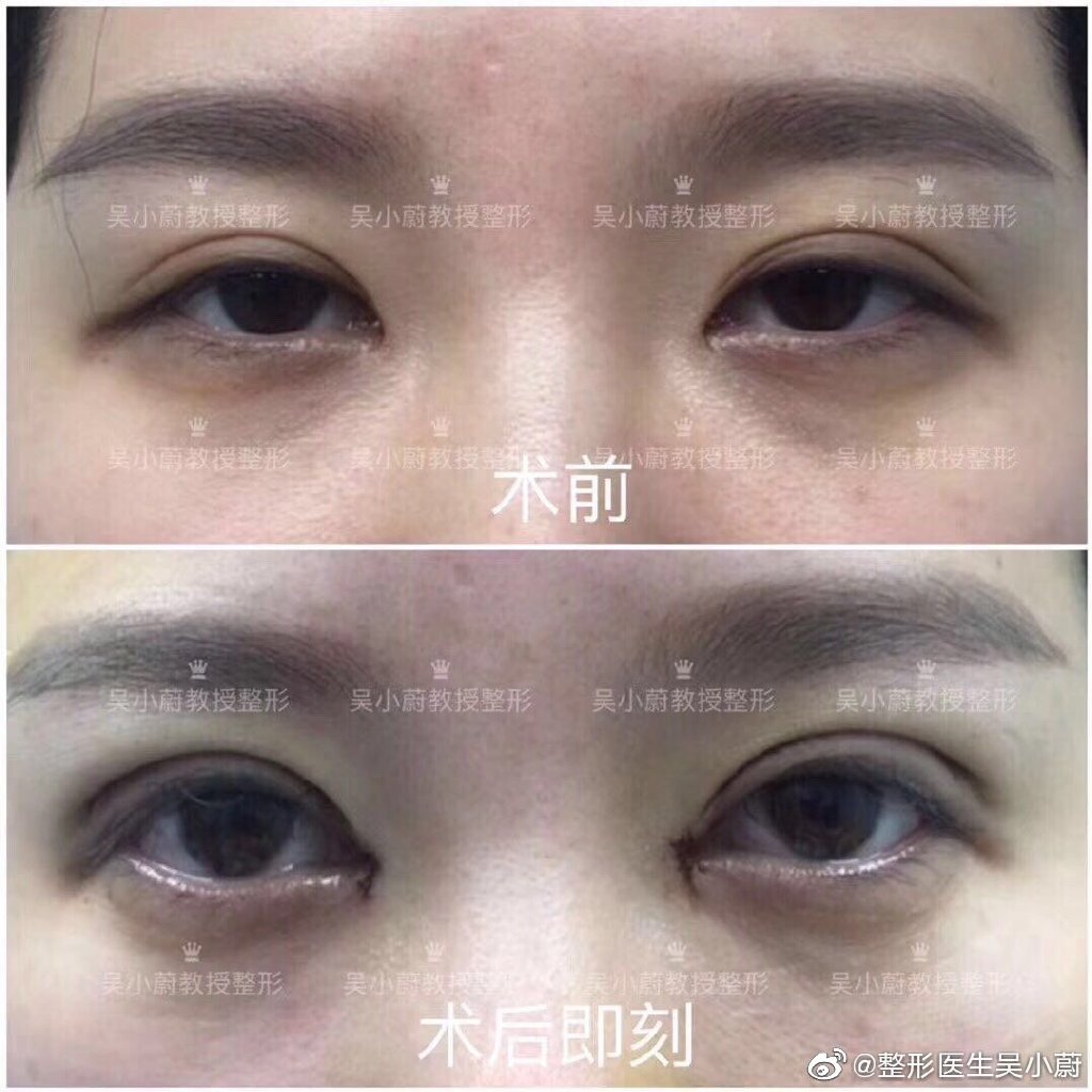 吳小蔚雙眼皮修復案例