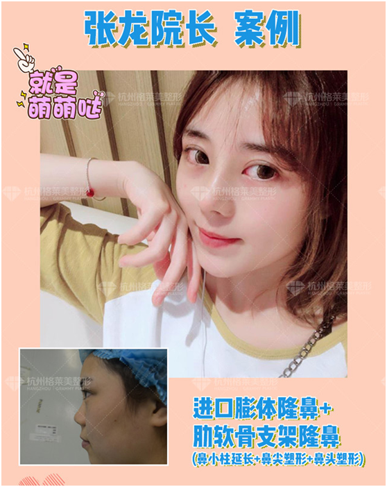 張龍肋骨鼻案例