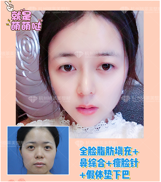 張龍肋骨鼻案例