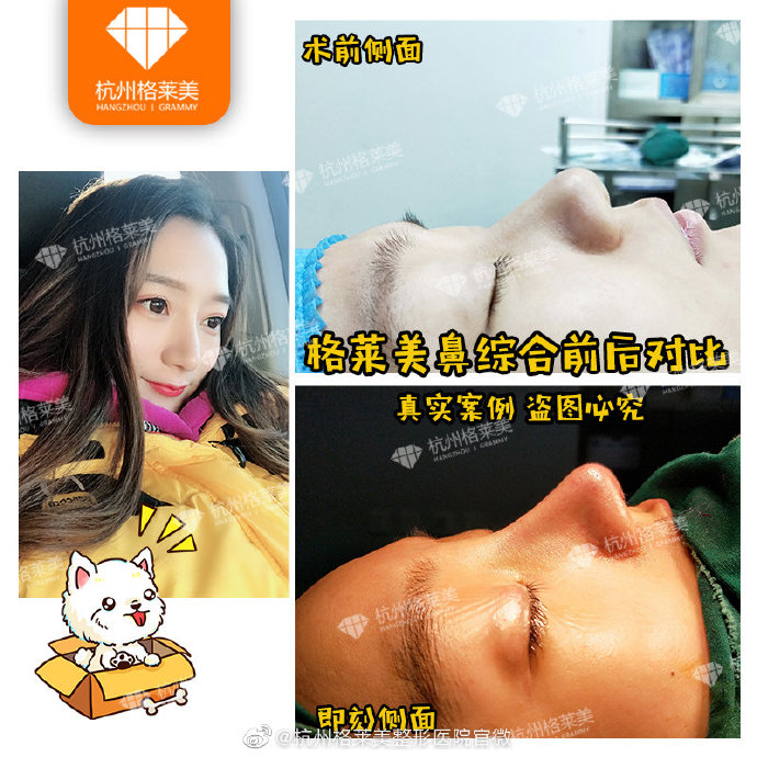 張龍肋骨鼻案例