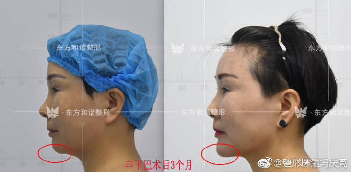 脂肪豐下巴