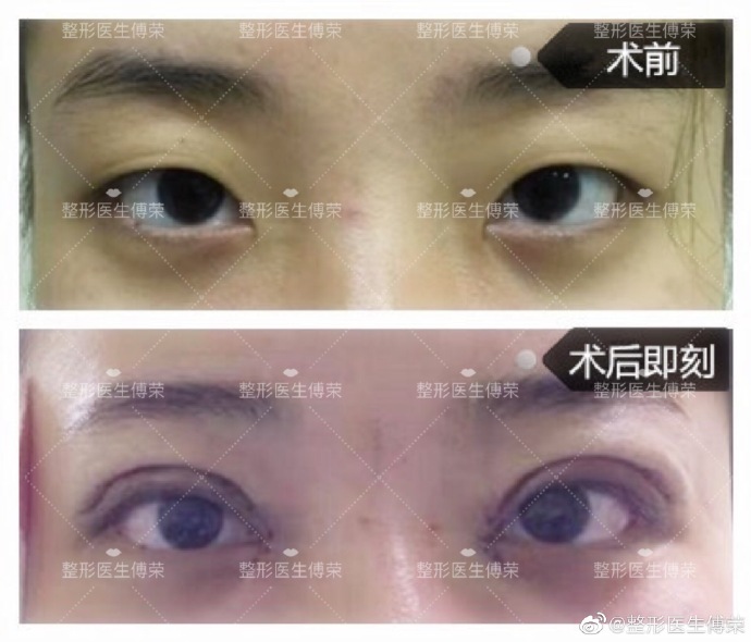 雙眼皮案例