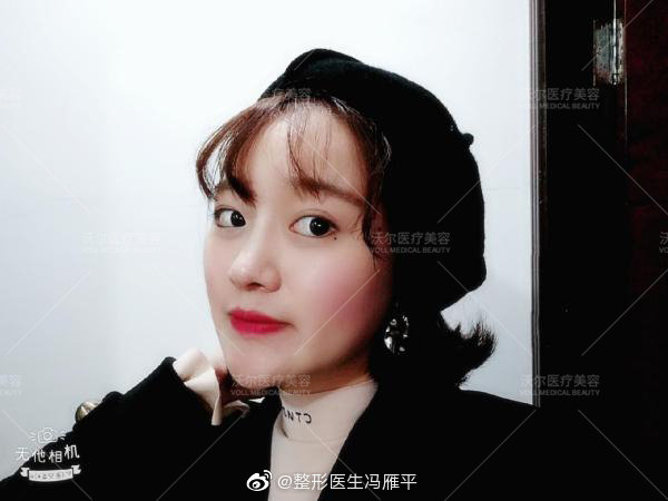 馮雁平隆鼻案例