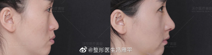 馮雁平隆鼻案例