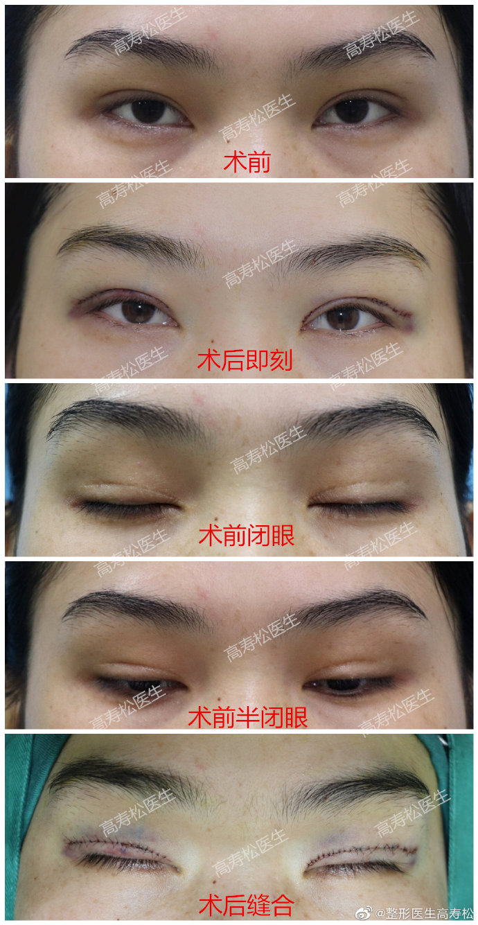 高壽松雙眼皮修復案例