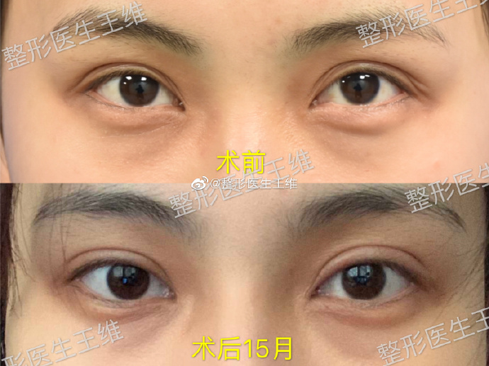 王維雙眼皮修復案例