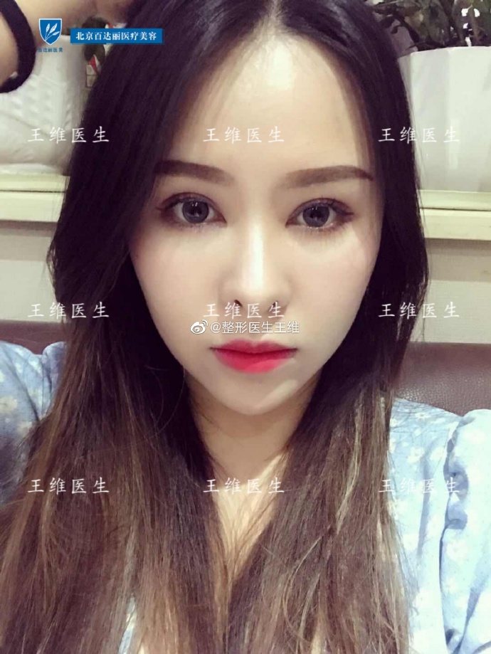 王維雙眼皮修復案例