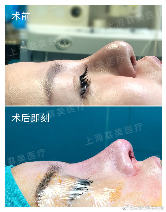 王會勇隆鼻案例
