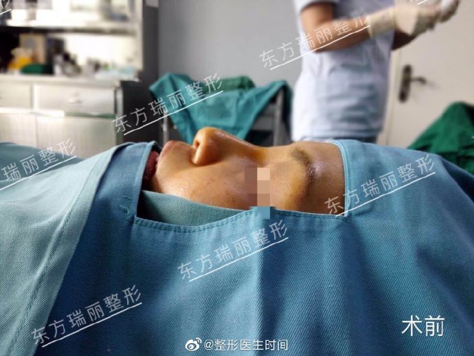 時間醫生隆鼻案例