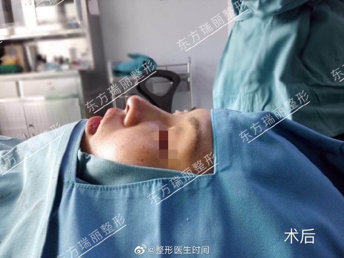時間醫生隆鼻案例