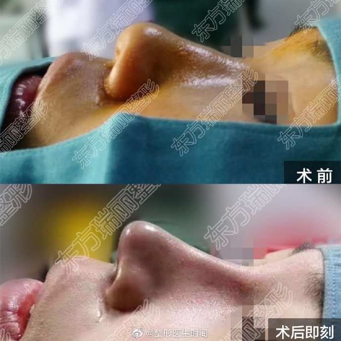 時間醫生隆鼻案例