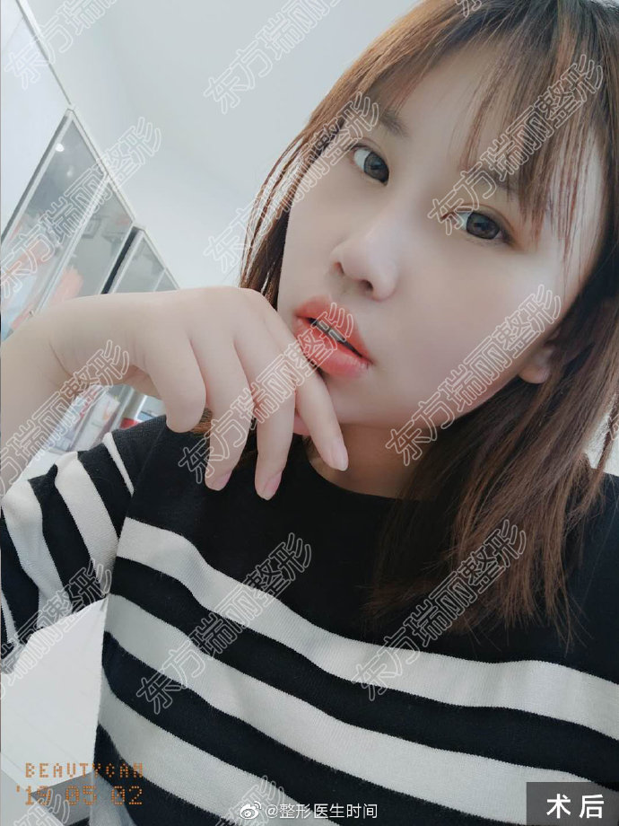 時間醫生隆鼻案例