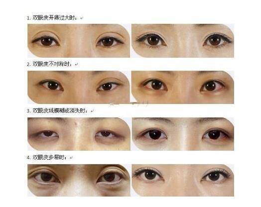 羅旭松雙眼皮修復(fù)案例