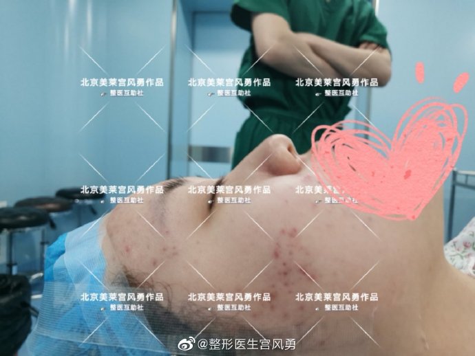 宮風勇鼻整形案例