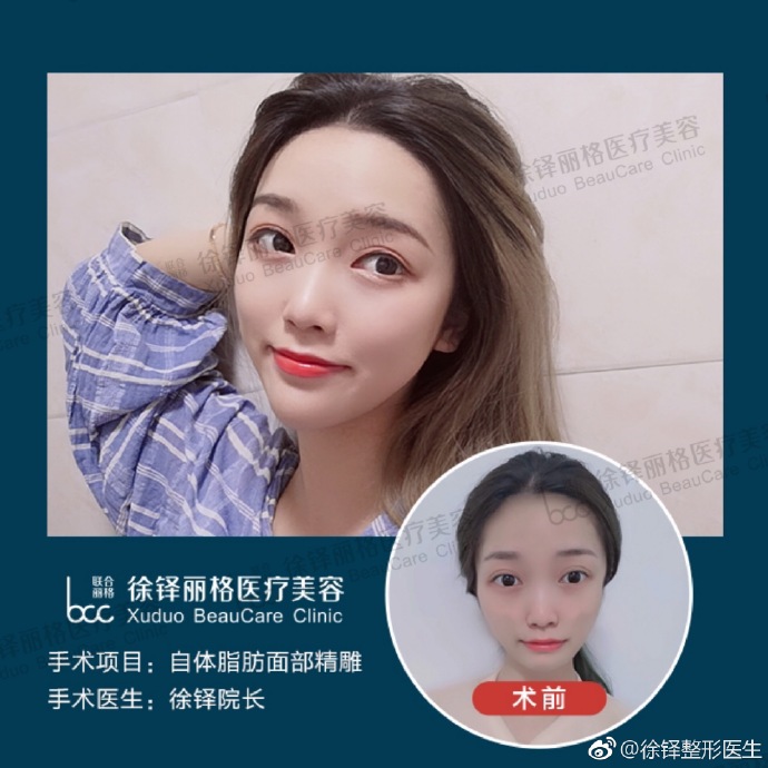 徐鐸面部精雕案例