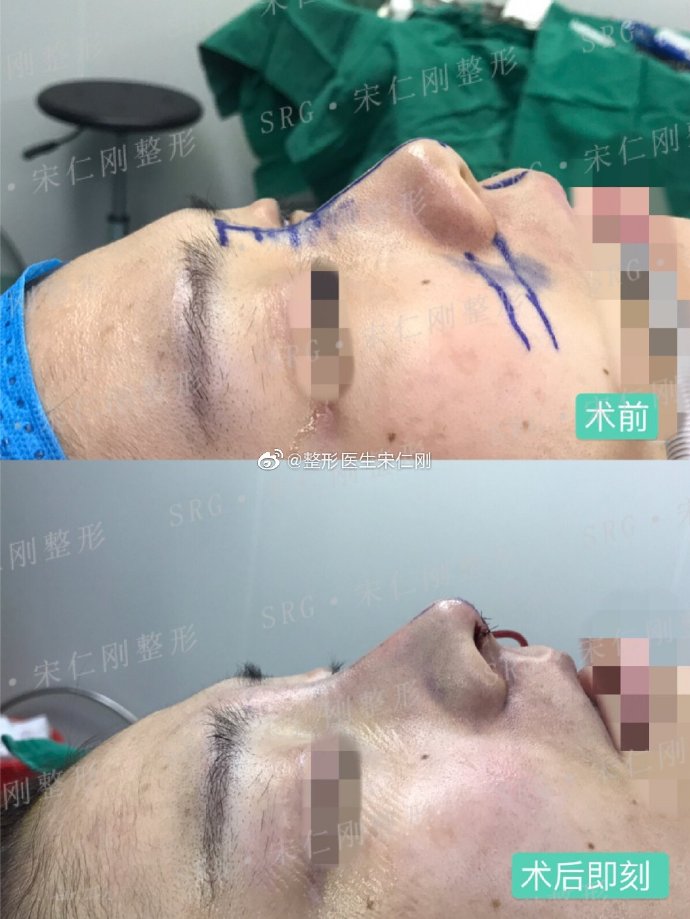 宋仁剛肋軟骨隆鼻案例