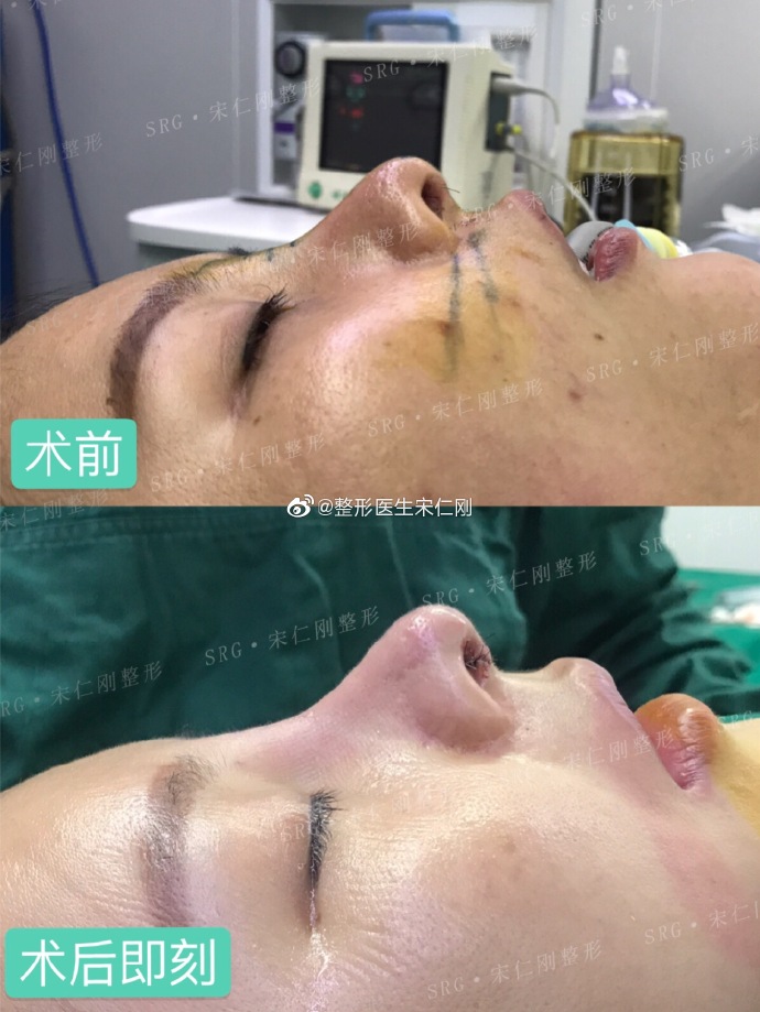 宋仁剛鼻修復案例