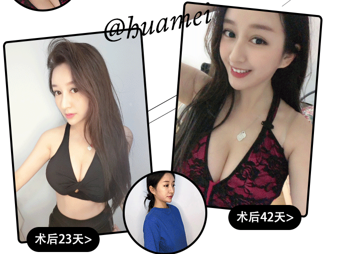牟北平豐胸案例