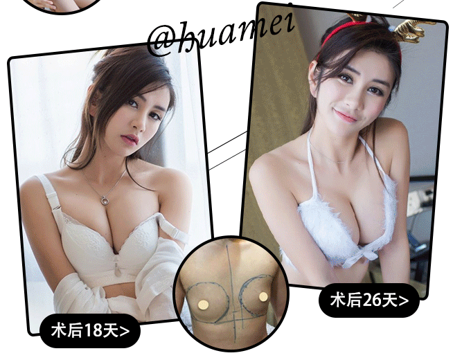 牟北平豐胸案例