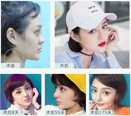 肋軟骨隆鼻案例